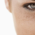 Pigmentation & Uneven Skin Tone