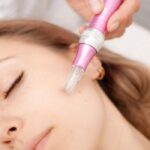 Microneedling Treatment By Dr. Chahal